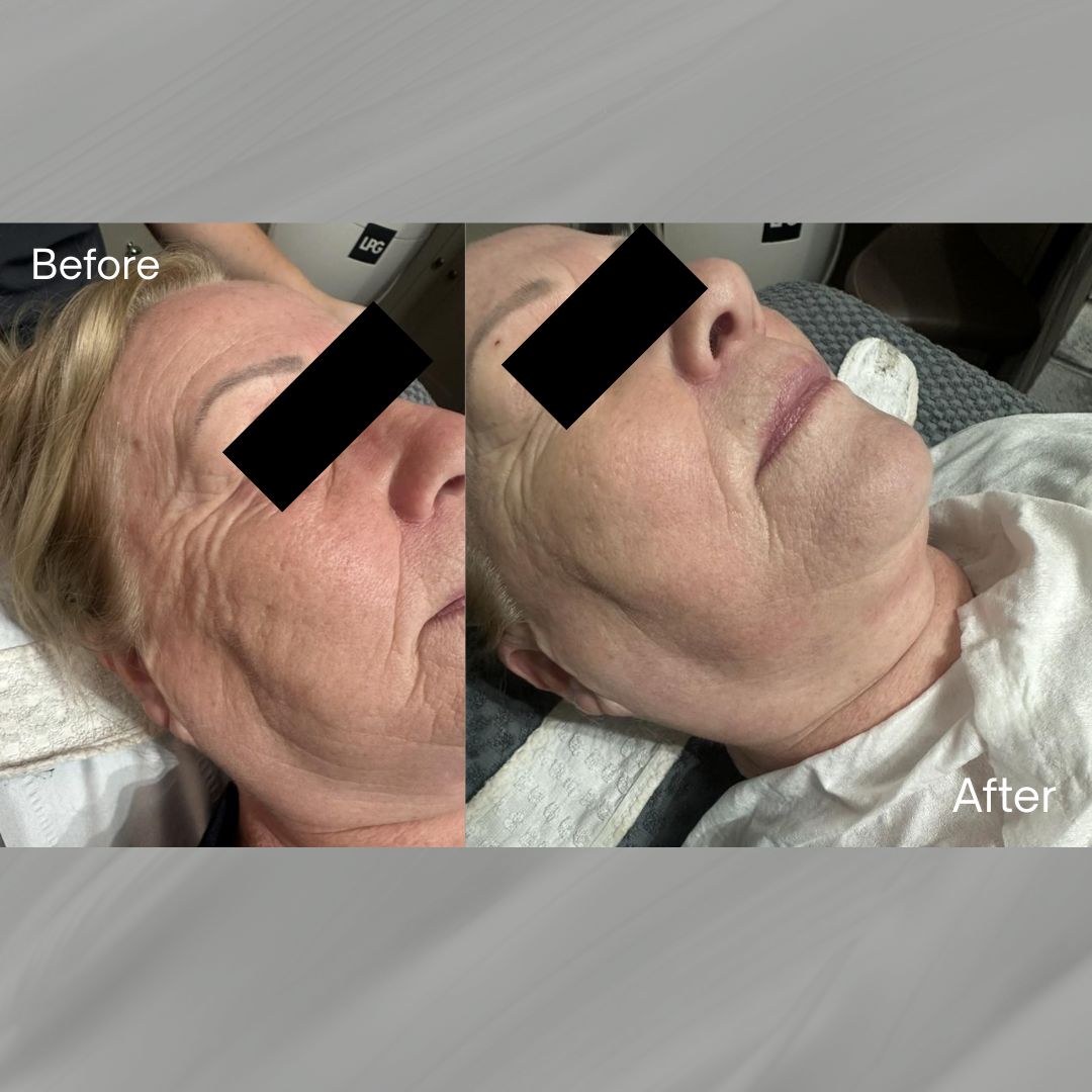 IPL Before & After ( Side Profile 2) By Millie 2026